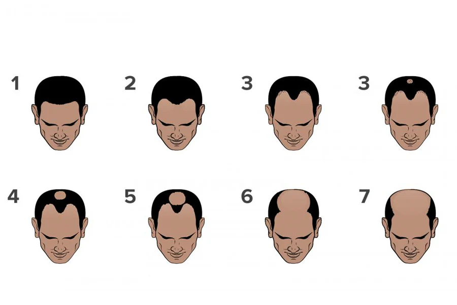 Hair Loss Scale