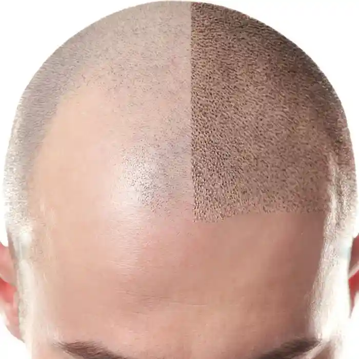 Scalp Micropigmentation