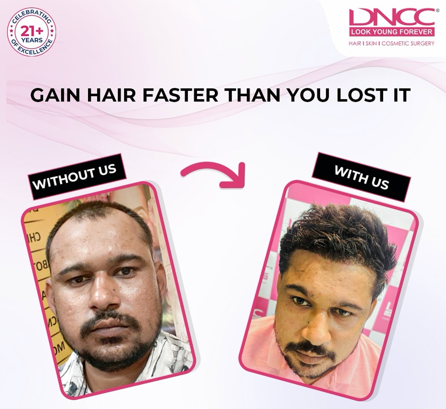 Are you seriously considering a hair transplant