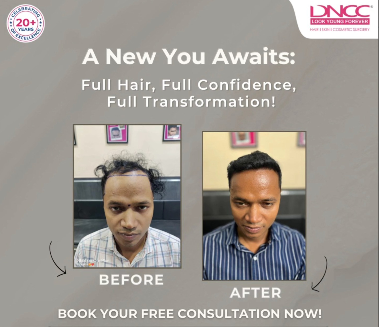 What is your approximate budget for hair transplant